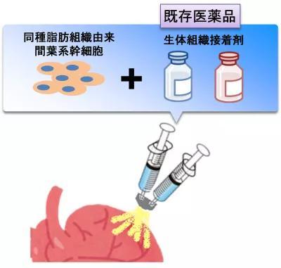 干细胞喷雾 大阪大学为心衰患者点亮新曙光